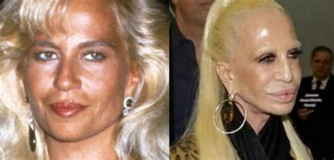 donatella versace pictures before and after